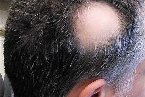 Global Laser Hair Loss Treatment Market Scope, Share and Size Estimation with Forecast till..