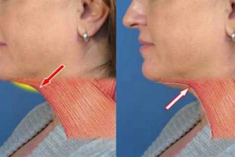 How to Lose Weight in Your Neck With Exercises to Lose Neck Fat
