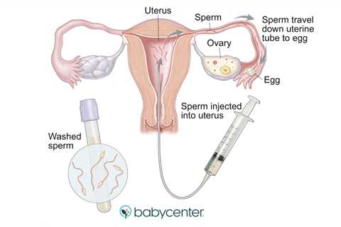 How Fertility Treatment Works