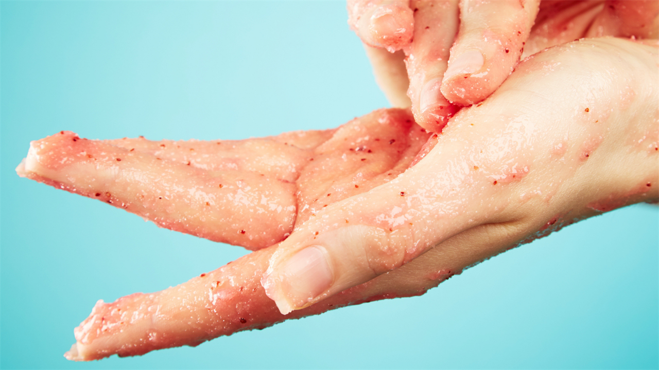 This DIY Miracle Scrub Naturally Cured One Woman's Eczema