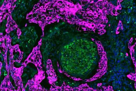 Researchers Look At Space Between Nerves And Tumor Cells To Identify Most Aggressive Oral Cancers