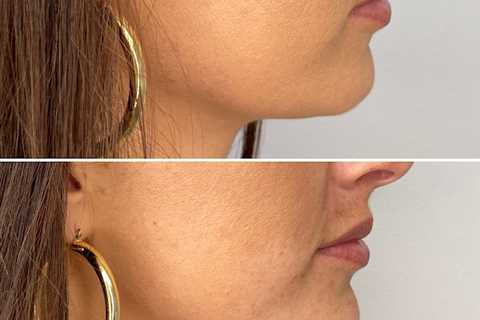 Skin Tightening, Botox and Lip Fillers by Skinsation LA