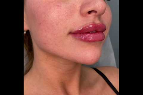 Jul 23, 2021 - Skin Tightening, Botox and Lip Fillers by Skinsation LAAddress: 6310 San Vicente..