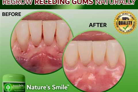 Natures Smile Receding Gums