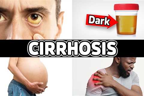 7 Warning Signs of Cirrhosis (End-Stage Liver Disease) - Dr. Berg