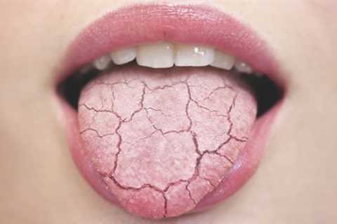 best natural remedies for dry mouth