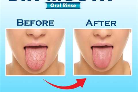 natural dry mouth mouthwash