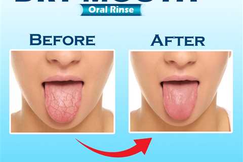 How do I know if I have dry mouth