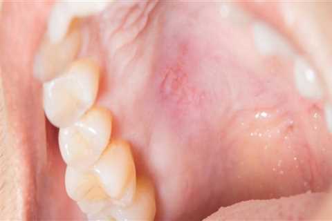 What are some examples of mouth diseases?