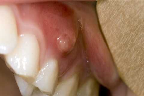 What is the cause of most oral disease?