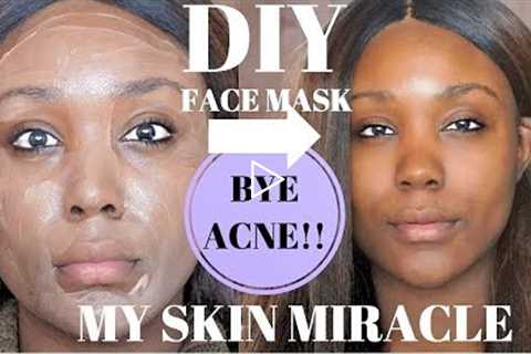 OILY SKIN ACNE CHEAP SKIN CARE ROUTINE!!! REMOVE ACNE/ DARK SPOTS CLEAR SKIN FAST  - Rose Kimberly