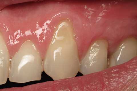 Gum Tissue Regrowth