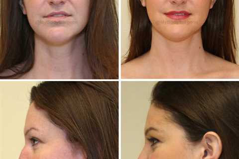 How Painful is Rhinoplasty