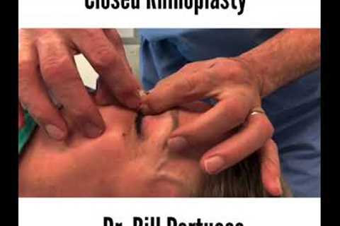 Closed Rhinoplasty Nose  Job Surgery Splint