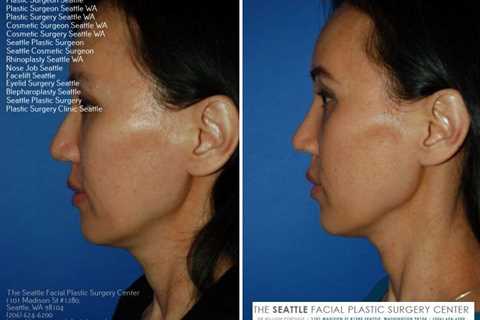Seattle Rhinoplasty - Dr William Portuese | Facial plastic surgery, Rhinoplasty, Facial plastic