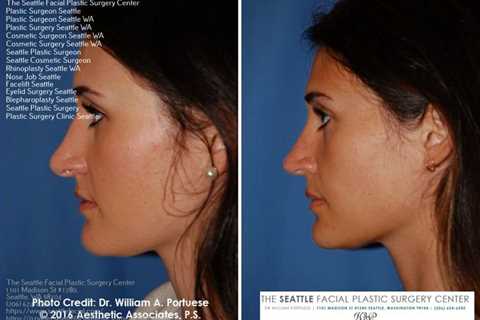 Non surgical neck lift near me | Rhinoplasty surgery, Rhinoplasty, Facial surgery