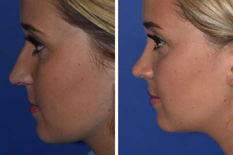 Rhinoplasty in Seattle Washington