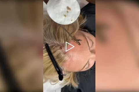 Popping huge blackheads and Pimple Popping - Best Pimple Popping Videos