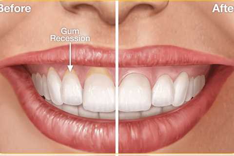 How Can I Reverse Gum Disease?