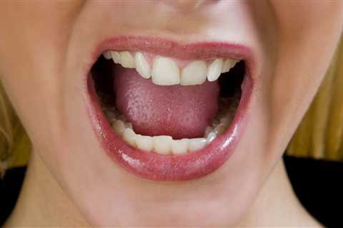 Burning Tongue (burning Mouth Syndrome): Causes And Home Remedies