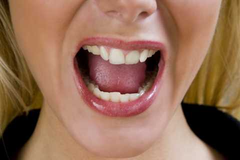 Burning tongue (burning mouth syndrome): Causes and home remedies