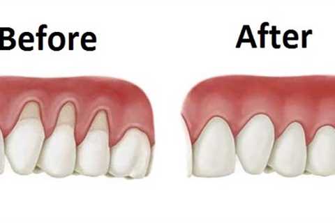 Natural Remedy for Receding Gums- Repair Gums