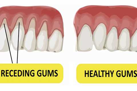 How to Have Healthy Gums Naturally- Repair Gums