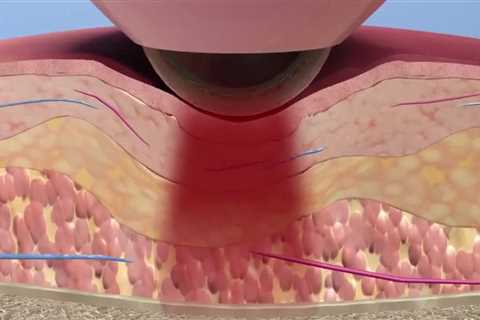 How laser works on soft tissue?