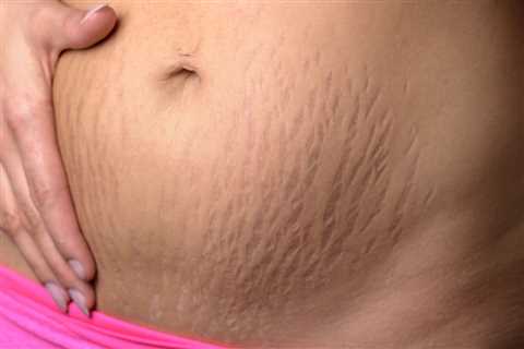 Can I Use Mederma Stretch Marks Therapy While Pregnant?