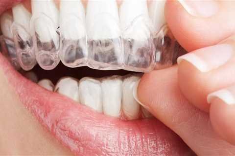 Can Invisalign Cause Fillings to Fall Out?