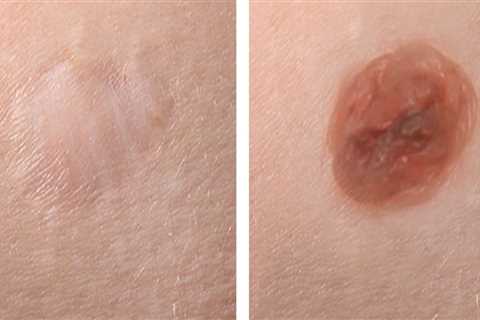 Risks of Shaving Technique for Mole Removal