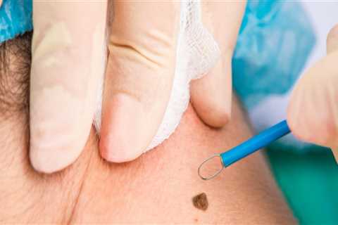 Cauterization: Everything You Need to Know about Non-Surgical Mole Removal