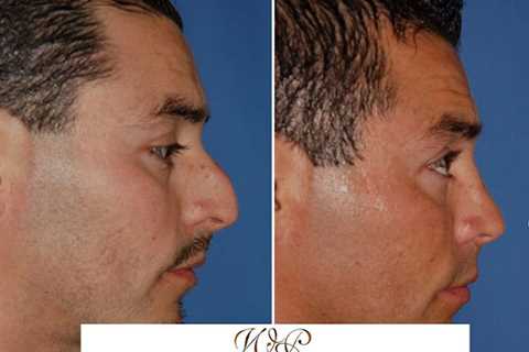 The Portland Center for Facial Plastic Surgery : Rhinoplasty, Facelift Surgery