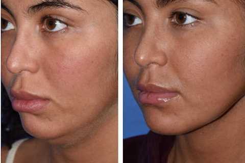 The Portland Center for Facial Plastic Surgery : Rhinoplasty, Facelift Surgery