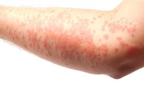 Skin Rashes and Hives: Causes, Symptoms, and Treatment