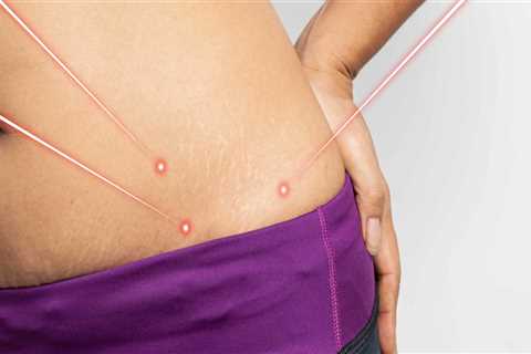 Does laser lipo get rid of belly fat?