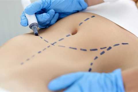 Mini, Fleur-de-Lis, or Extended Tummy Tuck: Which Is Right for You?