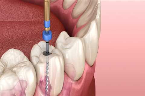 Does general dentistry include root canals?