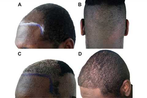 Hair Transplant In Indore Can Be Fun For Everyone