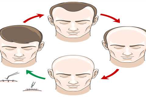 Little Known Facts About Hair Transplant In Indore.