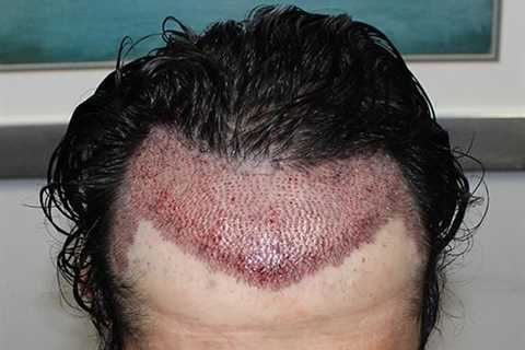 Hair Transplant In Indore Fundamentals Explained