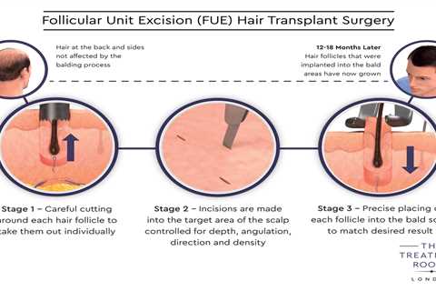 Some Ideas on Hair Transplant In Indore You Need To Know