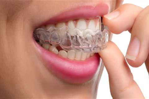 How Long Does it Take for Clear Aligners to Work?