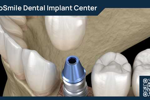 Standard post published to ProSmile Dental Implant Center at March 29, 2023 16:01