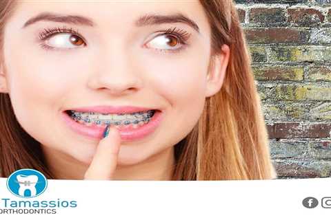 Standard post published to Tamassios Orthodontics - Orthodontist Nicosia, Cyprus at March 14, 2023..