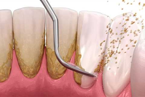 Can Laser Cleaning Help with Tartar Buildup?