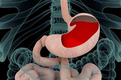 Can Cannabis Treat Gastroesophageal Reflux Disease (GERD)?