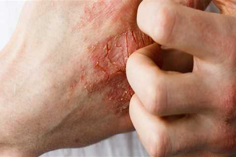 Eczema: A Comprehensive Overview