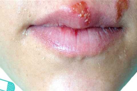 Testing for Oral Herpes: A Comprehensive Overview