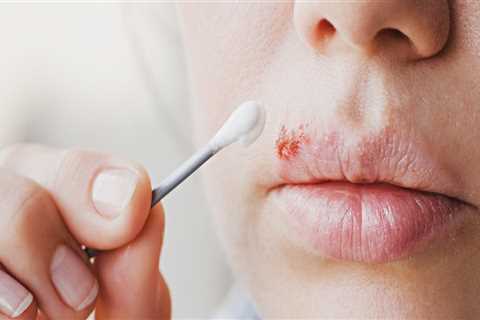 Pain Relievers: An Overview of Over-the-Counter Remedies for Herpes Lips